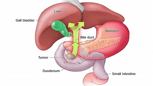 103K views · 611 reactions | The Whipple procedure is used to treat tumors and other disorders of the pancreas, intestine and bile duct. Watch as Dr. Horacio Asbun explains what happens during a Whipple procedure and learn more about this complex procedure: https://mayocl.in/3bbNFCI. | Mayo Clinic | Facebook