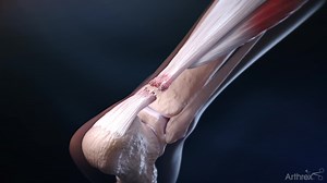 Achilles Midsubstance SpeedBridge™ Surgical Technique