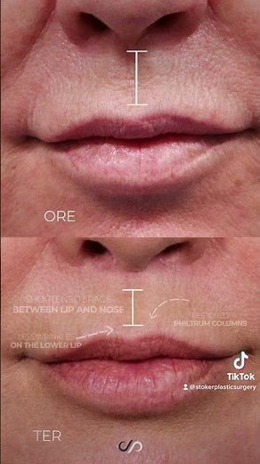 Lip Lift Surgery: Redefining Lips for Perfectly Plump Results | Los Angeles Plastic Surgeon