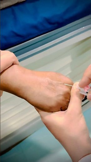 Understanding Canalization: Techniques, Benefits, and Best Practices in Intravenous Therapy