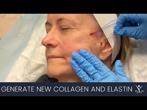 How Does a PDO Thread Facelift Work?