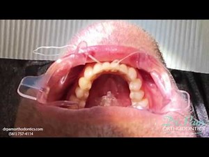 Fixed Retainer Placement After Braces Removal