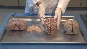 Brain Dissection 01 - Introduction to the Human Brain