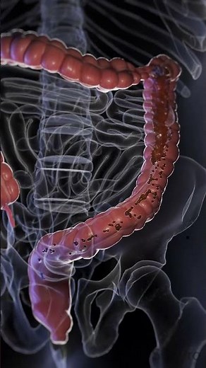 Understanding Diarrhea: Causes, Symptoms, and Management #anatomy #meded #3danimation