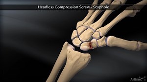 Headless Compression Screw – Scaphoid