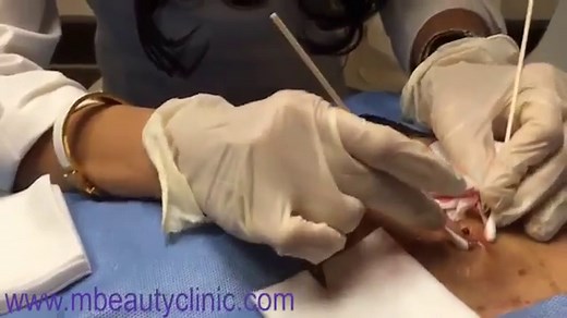 Dr. Tess Mauricio pops infected cyst