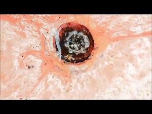 Monster Zit / Blackhead