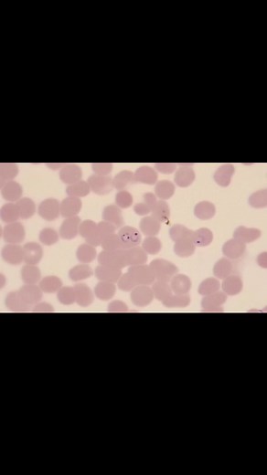 15K views · 371 reactions | Peripheral blood smear  #lablife #hematology #medicallaboratoryscience | Lab life | Facebook