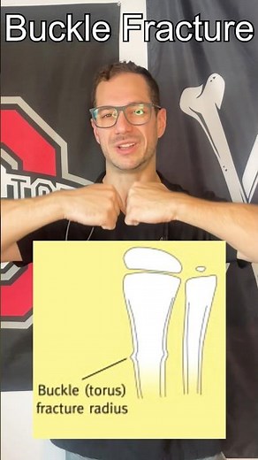 What is a Buckle Fracture? #shorts #bones #pediatrics