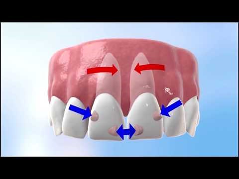 Discover how Invisalign works