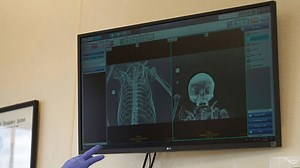 These are some of the strange objects that get stuck in people's bodies, according to CDC data