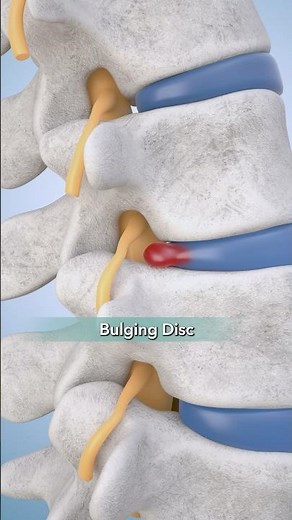 Bulging Disc Surgery: Julia's story!