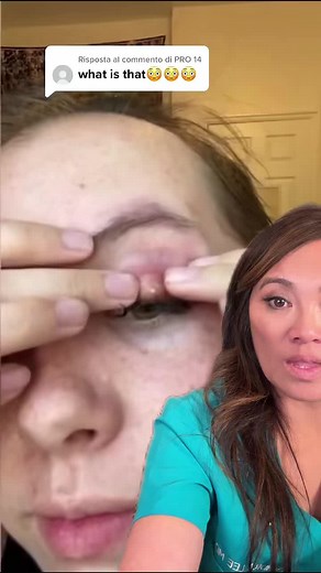 Stye Popping: Relieving the Pressure with Warm Compresses