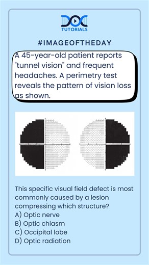 This Visual Field Defect Points to ONE Structure—Can You Identify It?