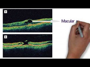 Optical Coherence Tomography - OCT | part-2