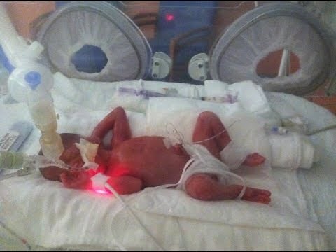Born at 25 Weeks: Micro-Preemie Documentary