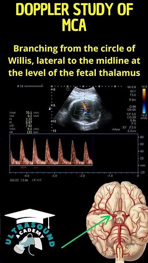 Quick Guide: Doppler Ultrasound of the Fetal Middle Cerebral Artery