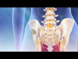 Interstim Overview Animation