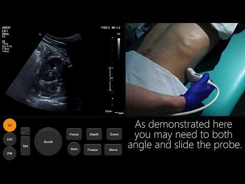 Ultrasound Tutorial: Kidney & Bladder / Urinary Tract | Radiology Nation