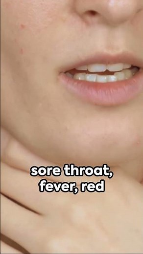 Strep Throat: Causes, Symptoms, and Diagnosis