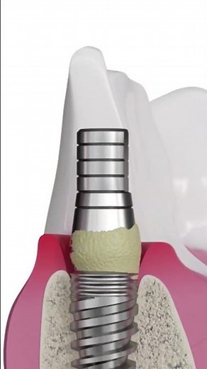 GDT Anti Virus Gel: defense against peri-implantitis