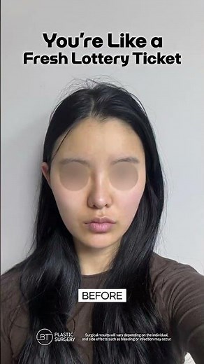 Korean V-Line Surgery Before & After | Best Facial Contouring Surgeon