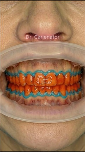 Professional Whitening Before & After: High-End Process 🦷✨