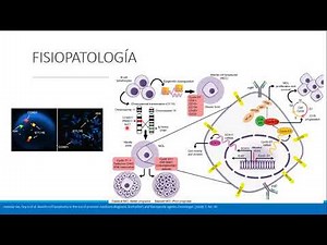 LINFOMA DE CÉLULAS DEL MANTO