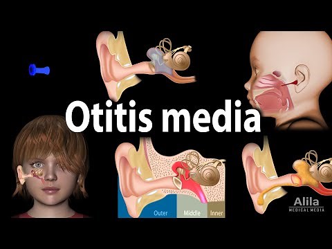 Otitis Media: Anatomy, Pathophysiology, Risk Factors, Types of OM, Symptoms and Treatment, Animation