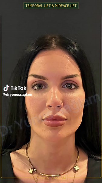 Just one week after surgery, and her happiness says it all ✨ Temporal Lift & Midface Lift & Canthoplasty #temporallift #midfacelift #canthoplasty #dryunussaglam #surgerytiktok