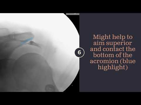 1 Minute Shoulder Subacromial Bursa Injection