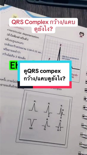 Understanding QRS Complex in EKG Analysis for Nurses