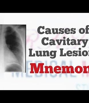Causes of Cavitary Lung Lesions | Mnemonic "CAVITARY" for all causes of lung cavities | MedSurvival
