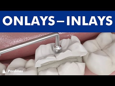 Dental inlays and onlays ©