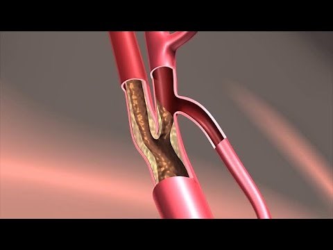 Endarterectomy Treatment
