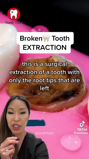 Broken Tooth? If you have a broken tooth, how do you broken at the gumline, the tooth cannot be saved and needs an extraction. first, the tooth is elevated using a surgical elevator. Then forcepts are used to extract the tooth out of the socket. #t#toothextraction#b#brokentoothp#pulledtoothD@Dr. Nate | Orthodontist#d#dentistsoftiktok#d#dentalsurgery