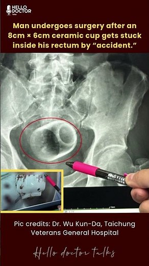 Man undergoes surgery after an 8cm × 6cm ceramic cup gets stuck inside his rectum by “accident.”