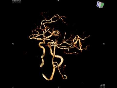 Advanced Brain Imaging: MRA Volume Rendering