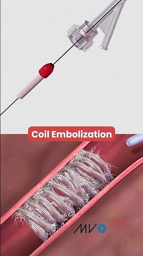 What Is Coil Embolization? | Animated Medical Explanation