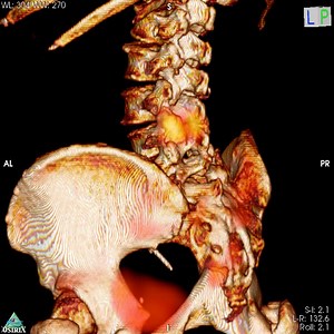 Nuclear Medicine Studies: SPECT-CT of the spine