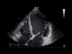 Transthoracic Echocardiography: Dilated cardiomyopathy 3, Functional MR (4ch zoom)