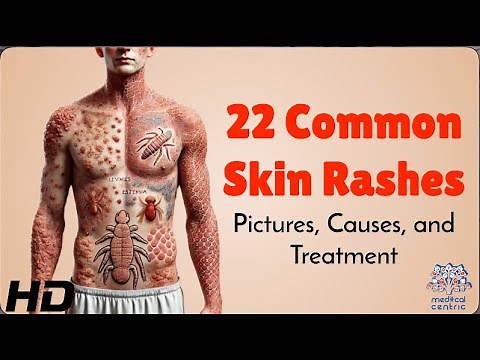 22 Skin Rashes Everyone Should Know About: Symptoms & Treatments