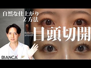 【よくわかる 目頭切開 症例解説】BIANCA CLINIC