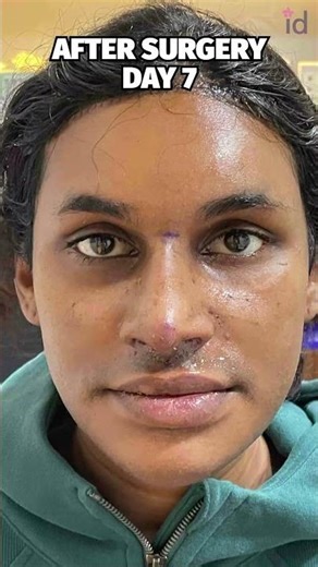 Alexa's Beautiful Journey | Facial Feminization Surgery at ID Hospital Korea