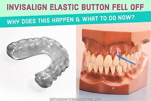 What To Do If Invisalign Elastic Buttons Fell Off - Orthodontic Braces Care