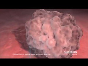 Cystoscopy Explained