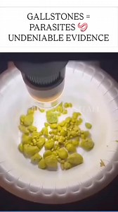 Gallstones/Gallbladder Issues & Parasites: The Hidden Connection Many holistic practitioners believe that certain parasites block bile flow, disrupt digestion, and contribute to gallstone formation. How Parasites Cause Gallstones 1️⃣ Parasites Block the Bile Ducts 🔸 Liver flukes, roundworms, and Giardia can invade the liver & gallbladder, blocking bile flow and leading to stagnation. 🔸 Without proper bile flow, cholesterol & toxins crystallize into gallstones. 2️⃣ Parasite Waste Thickens Bile 