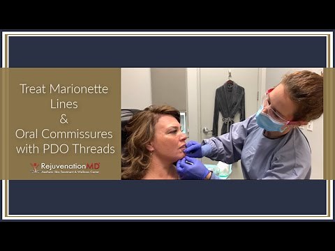 Treating Marionette Lines and Oral Commissures with PDO Threads