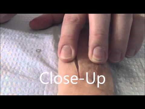How to Close a Wound in Seconds With Surgical Staples