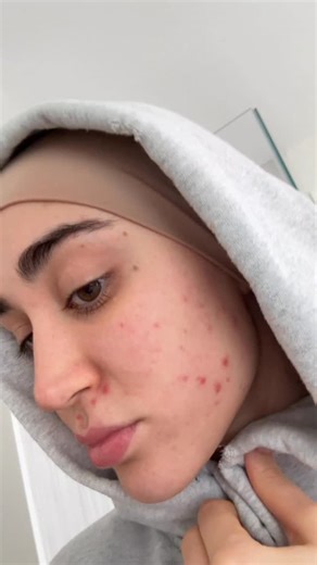 Leana Deeb on Instagram: "Skin Update: 8 weeks ago, I decided to take control of my skin and started working with @miaskinbar using @facerealityskincare . This brand finally feels right for me, and I love that I not only have a routine that actually works, but also genuine support from a certified acne expert that makes me feel understood. Consistency has been key, and the results speak for themselves: clearer skin, stronger barrier, and confidence that is seen and felt. These Face Reality produ
